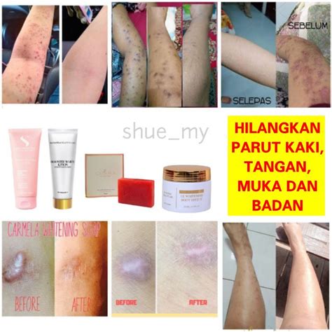 cara nak hilangkan parut jerawat