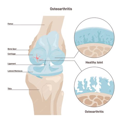 Premium Vector | Osteoarthritis Degenerative joint disease Worn out ...