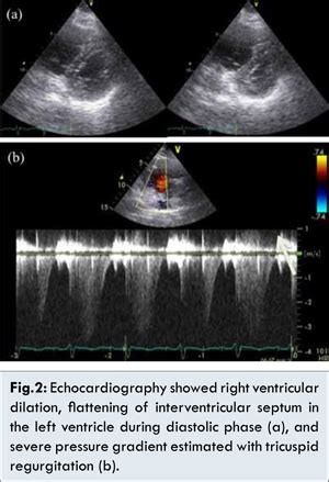 Pulmonary Tumor Thrombotic Microangiopathy by Lung Adenocarcinoma