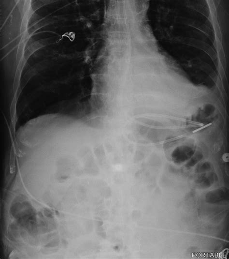 Gastrostomy Tube Xray at Christy Nathan blog