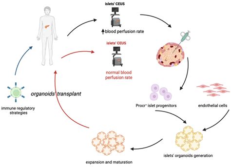 Insulitis in Human Type 1 Diabetic Pancreas | Encyclopedia MDPI