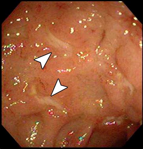 Crohn Disease of the Small Bowel: Preliminary Comparison among CT Enterography, Capsule ...