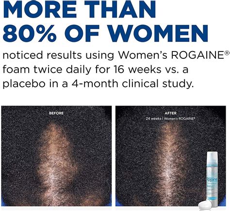 Hair loss treatment Minoxidil