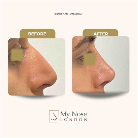 Nasal Polyps Treatment & Surgery | Specialist ENT Care