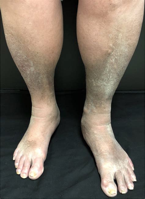 Peripheral Edema Vs Lymphedema at Jason Lyon blog