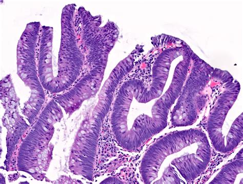 Thyroid Adenoma Histology