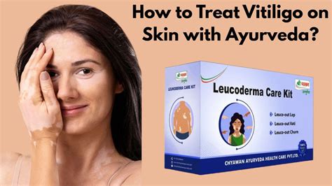 How to Treat Vitiligo / White Spots on Skin with Ayurveda?