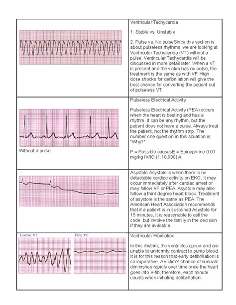 Ventricular Tachycardia and Related Arrhythmias Study Notes - Studocu