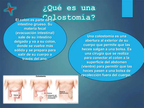que es colostomia, cual es su importancia | PPT | Descarga Gratuita