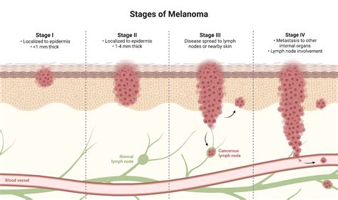 Melanoma Stages
