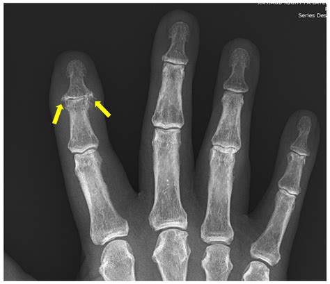 Mild Arthritis Hands