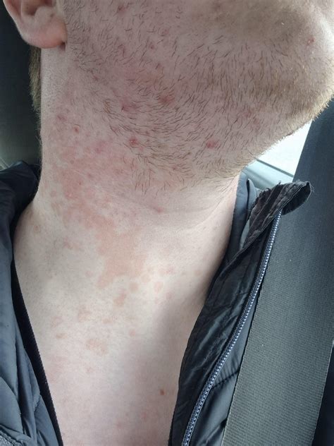 Dot Rash On Neck at Mason Mullan blog