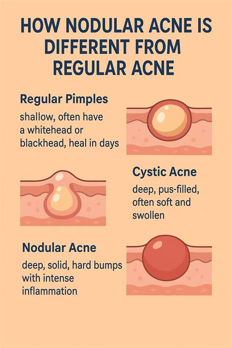Nodular Acne: Causes, Symptoms, and Best Treatment Guide