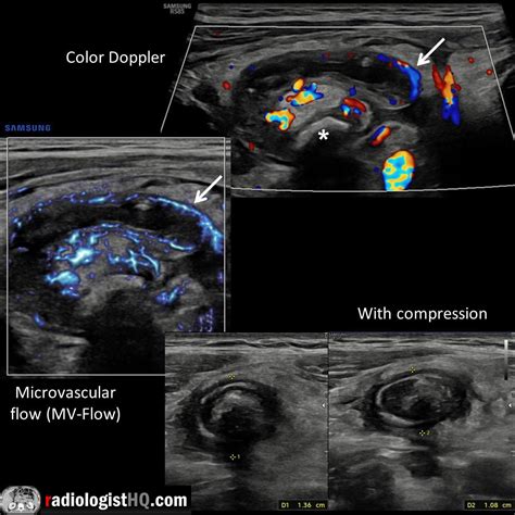 Perforated appendicitis on ultrasound & CT : r/Radiology