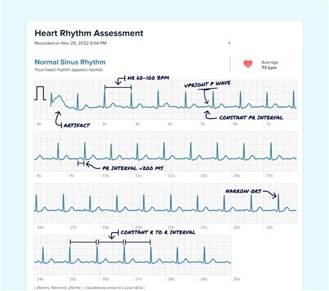 Sinus Rhythm Vs. Ectopic Atrial Rhythm on Your Watch ECG | Qaly
