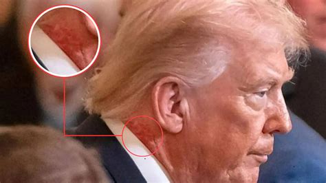 Donald Trump's Neck Appears To Have Redness And Rashes, White House ...
