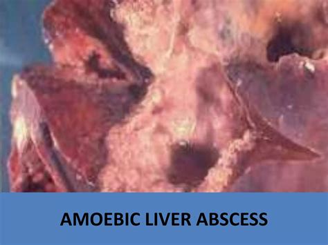 AMOEBIC LIVER ABSCESS | PPTX