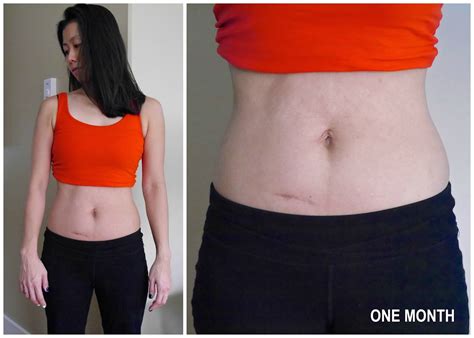 SILK’N SILHOUETTE The Ultimate Body Contouring System ~ The Final Check-in (10 weeks ...