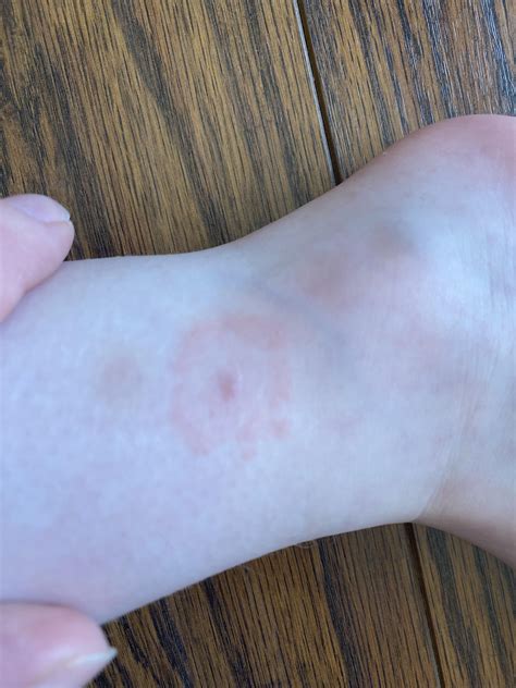 Does this look like a bullseye? Bite on my 3 year olds ankle after playing in yard. : r/Lyme