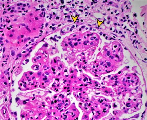 Rapidly Progressive Glomerulonephritis Em