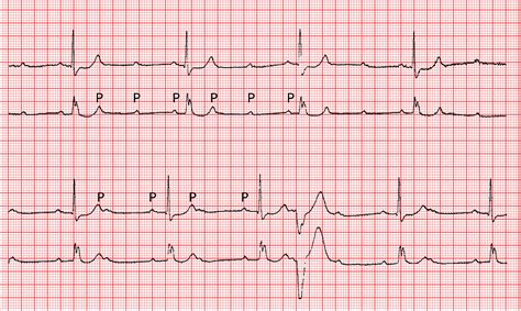 AV-Blockierungen - ECG