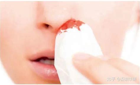 流鼻血的原因（流鼻血是什么引起的） | 说明书网