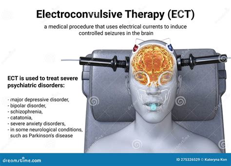 What Is Electroshock Therapy