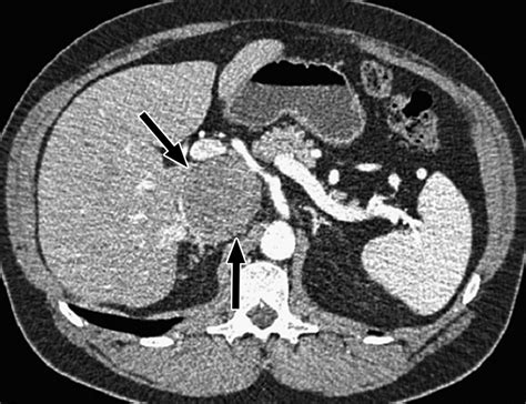 Imaging of the Inferior Vena Cava with MDCT | AJR