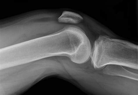 Ultrasound for knee effusion: lipohaemarthrosis and tibial plateau fracture - Rippey - 2014 ...