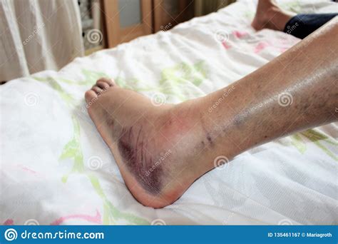 A Blue And Swollen Foot With Ankle Fracture Stock Image - Image of ...