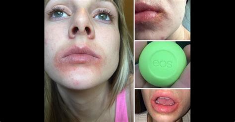Class-action lawsuit: EOS lip balm causes severe blisters, rashes | FOX ...