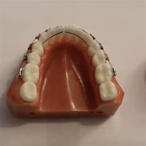 Broken bonded retainer advice | Garstang Dental