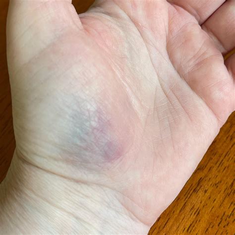 Bruised Palm Of Hand