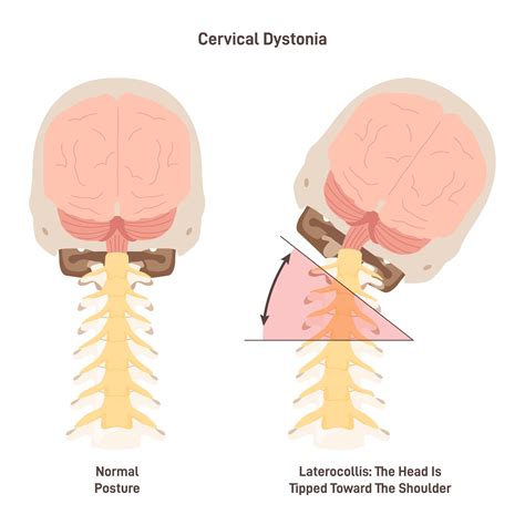 Acute Dystonia Drugs And Toxic Agents That May Cause Dystonia In