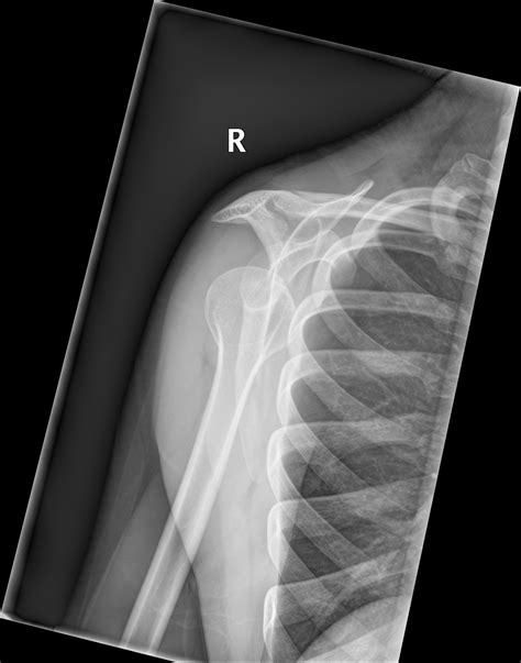 Inferior Shoulder Dislocation X Ray at Jeff Updike blog