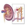 Questions about Nephrotic Syndrome