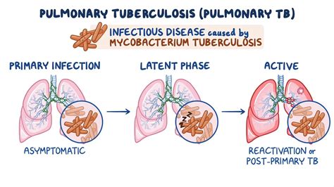 Tuberculosis (pulmonary): Video & Meaning | Osmosis