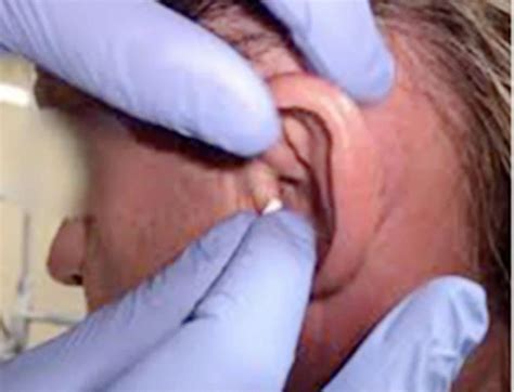 Ent Products - Netcare Ear Wicks/ Dressing for stopping Ear Bleeds ...