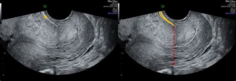 Contractions of the lower uterine segment during transvaginal ...