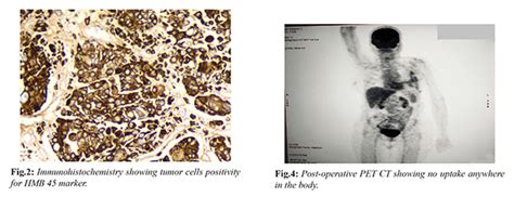 Primary Malignant Melanoma of Breast: A Rare Entity