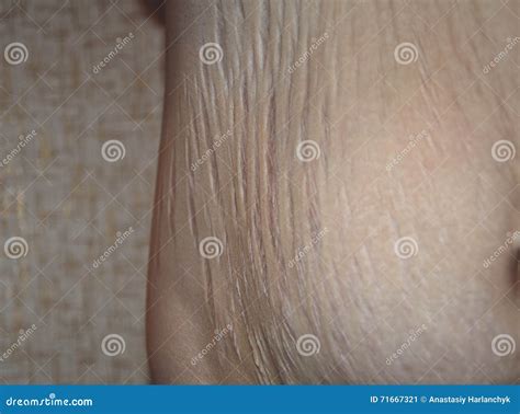 Stretch Marks after Pregnancy Stock Image - Image of abdomen, youth ...