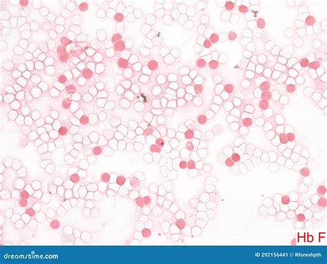 Kleihauer–Betke Test (fetal Hemoglobin Stain). Stock Illustration ...