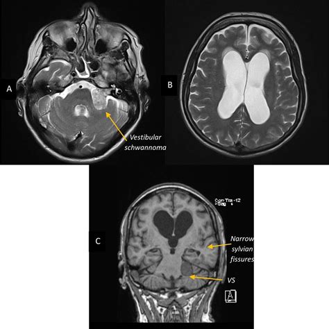 Hidrocephalus Mr Classical Concepts Of Hydrocephalus | Radiology Key