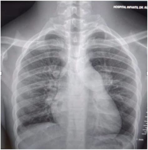 Pulmonary Embolism X Ray