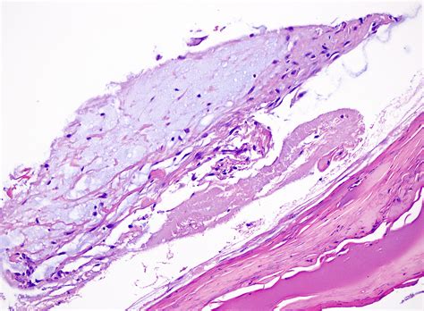 Pathology Outlines - Digital myxoid cyst