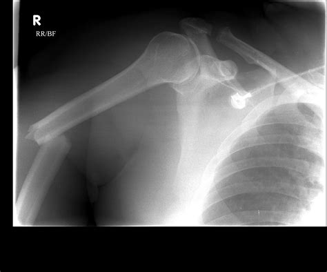 Proximal, Mid-Shaft, and Distal Humerus Fractures