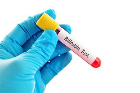 बिलीरुबिन ब्लड टेस्ट क्या है, कीमत और सामान्य स्तर - Bilirubin Blood ...