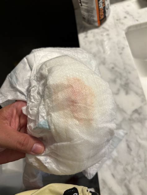 Blood in diaper | BabyCenter