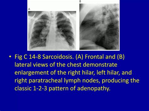 14 hilar and mediastinal lymph node enlargement | PPTX