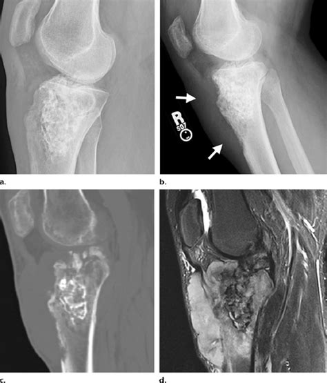 Malignant transformation of a GCT. (a) Lateral radiograph of the right ...